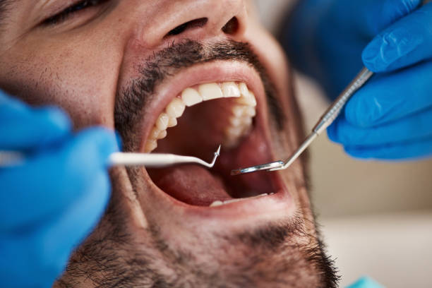 Best Emergency Dentist for Lost Fillings or Crowns in Valencia, NM